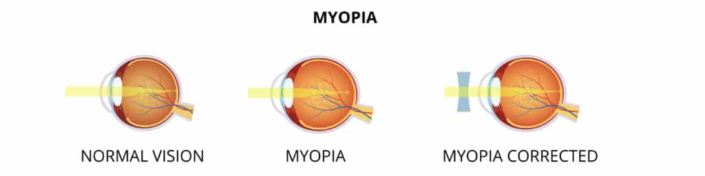 Kurzsichtigkeit - Myopia