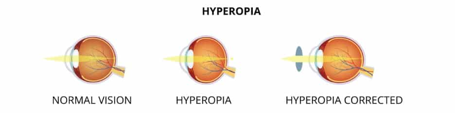 Hyperopia