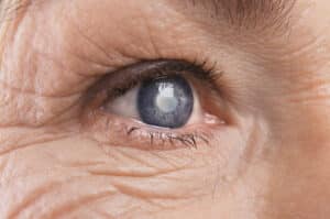 Grauer Star: Neue Erkenntnisse zur OP-Nachsorge Dreifach geschütztes Auge: Brillengläser mit UV-, Blaulicht- und Infrarotschutz vermindern ernste Folgeschäden nach der Kataraktoperation